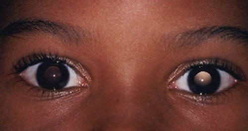 A Starry Gaze: Photorefraction Improves Vision for Children (NASA, 2/25/09)